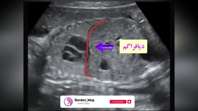 سونوگرافی جنین | تنفس جنین در رحم مادر که جالب است ببینید!