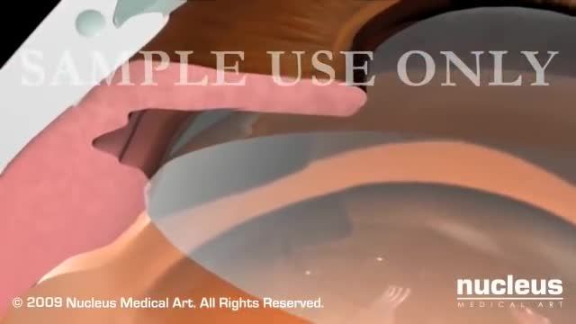 فیلمی کوتاه از جراحی گلوکوم