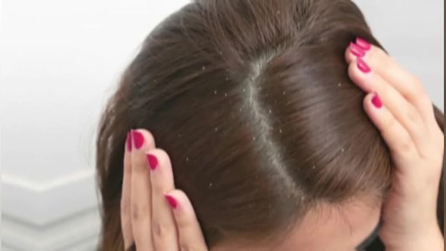 درمان شپش موی سر | شپش مو را چگونه از بین ببریم؟
