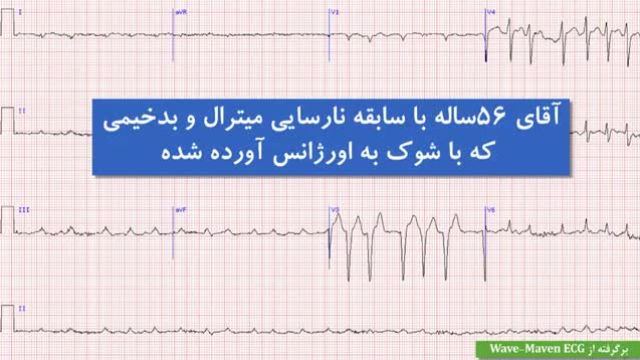 تمرین نوار قلب (الکتروکاردیوگرام) | بخش 8