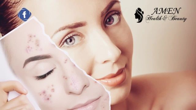 7 روش شگفت انگیز برای درمان جوش صورت