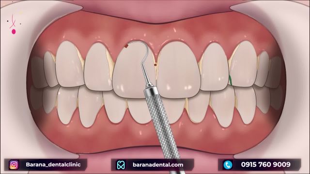 چگونه جرم گیری عمیق دندان انجام می شود؟