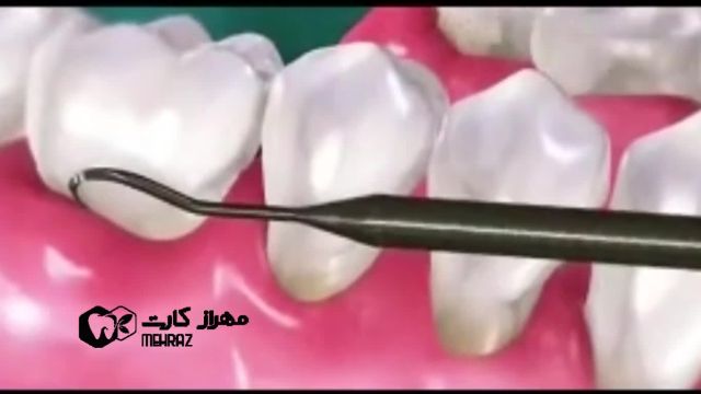 جرمگیری دندان (سفید کردن دندان)