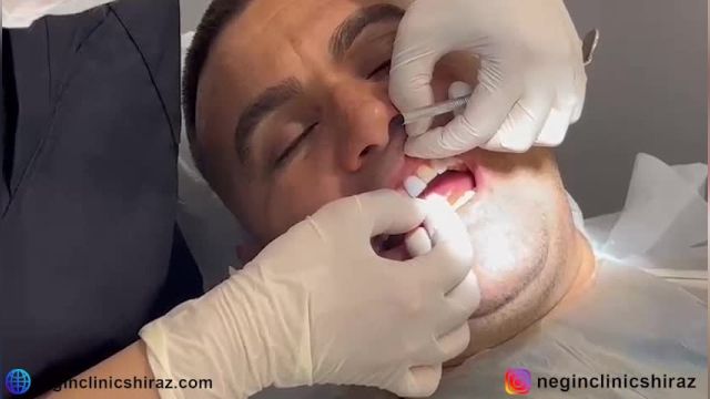لمینت دندان در کلینیک دندانپزشکی نگین شیراز