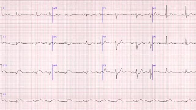 تمرین نوار قلب (الکتروکاردیوگرام) | بخش 16