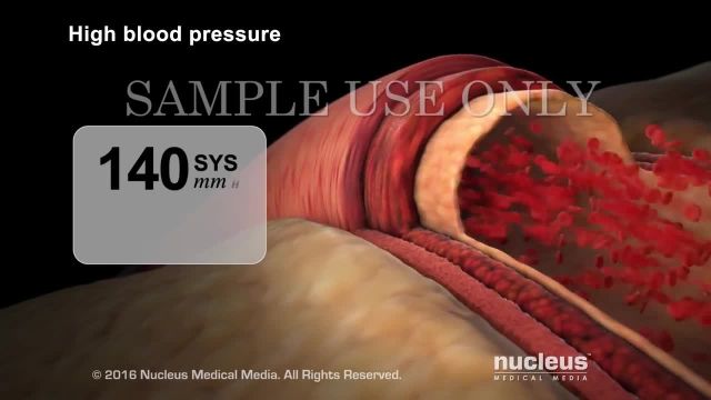 نحوی تشخیص فشار خون بالا | ویدیو