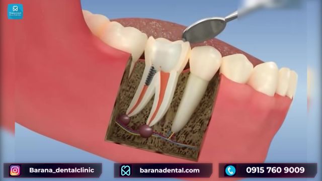 مراحل انجام عصب کشی دندان