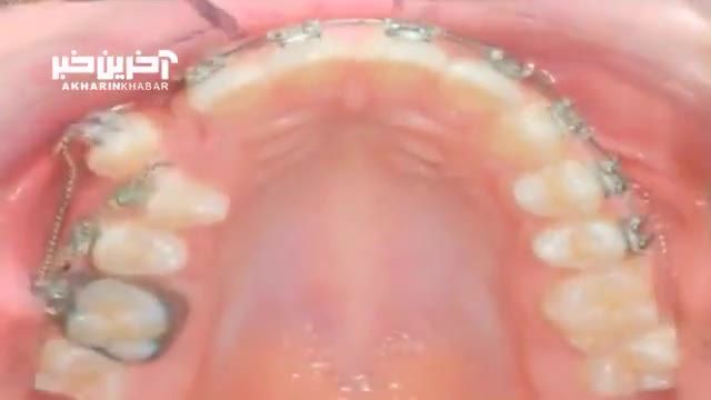 تایم‌ لپس ارتودنسی دندانها