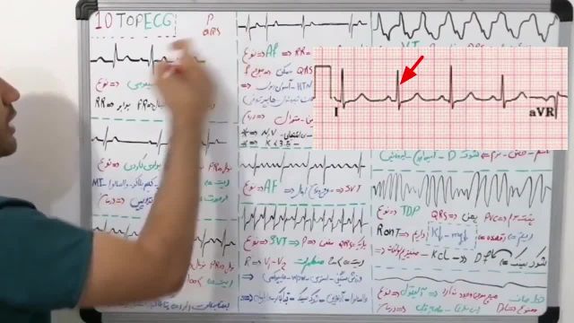 تفسیر 10 نوار قلب مهم در بیمارستان که باید بلد باشید!