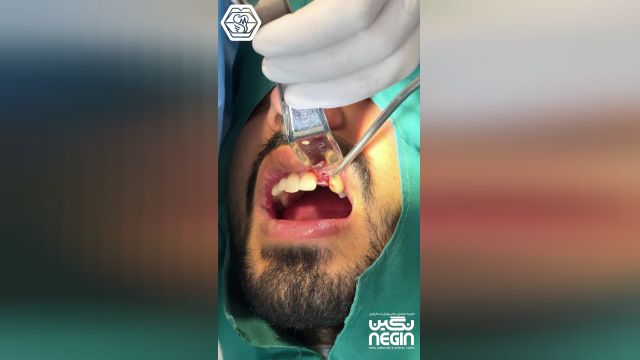مراحل کاشت ایمپلنت و پیوند استخوان - دکتر محمد طیبی - جراح دندانپزشک