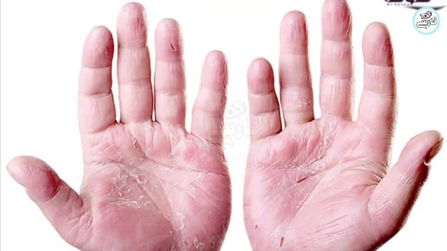 تشخیص وضعیت سلامتی با نشانه هایی که روی دست ها ظاهر می شوند!