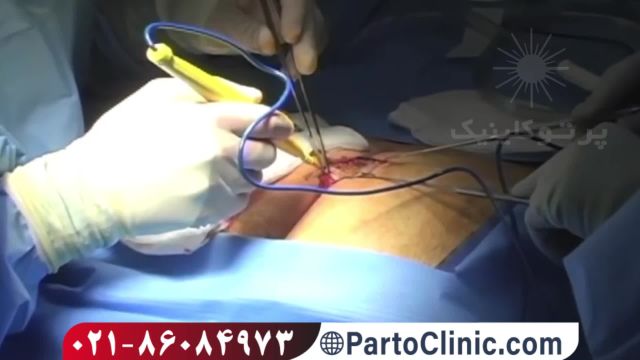 فیلم عمل جراحی سنتی کیست مویی با بخیه- پرتو کلینیک