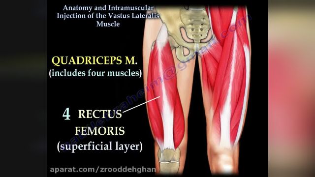 آموزش کامل تزریق عضلانی در عضله وستوس لترالیس Vastus Lateralis