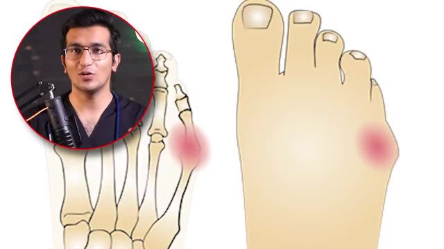 قوز انگشت پا | درمان انحراف انگشت پا با کش | این ویدیو را از دست ندهید!