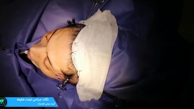 جراحی لیفت شقیقه برای زیبایی | ویدیو
