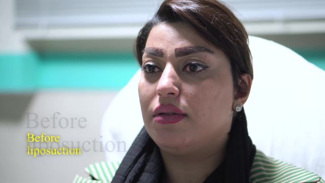 ساکشن غبغب در کلینیک سلامت ایده آل مشهد