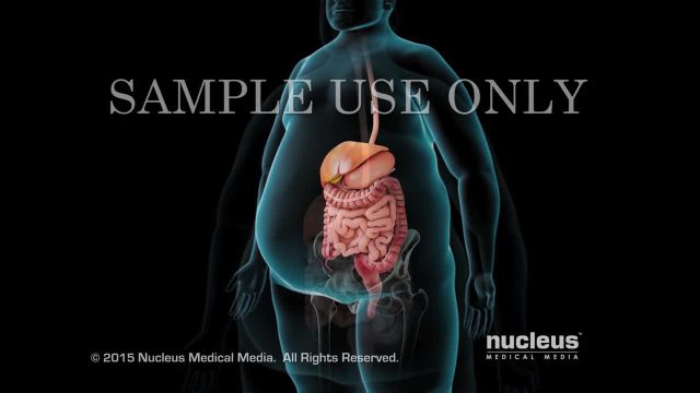 جراحی چاقی رباتیک |  ویدیو