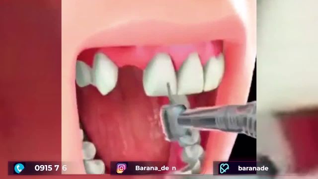 پروتز دندان در چه مواردی کاربرد دارد؟