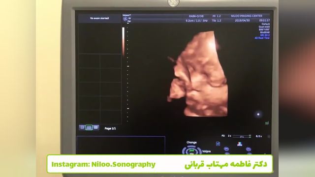 بیضه نهفته جنینی و تشخیص آن در سونوگرافی های پایانی بارداری!
