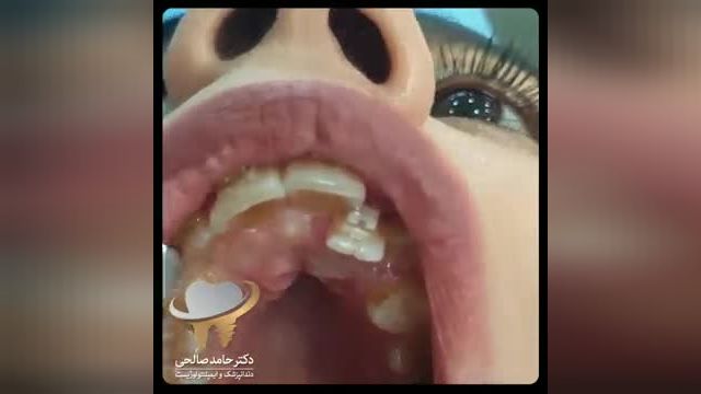 ویدیویی از جراحی خارج کردن دندان نیش نهفته