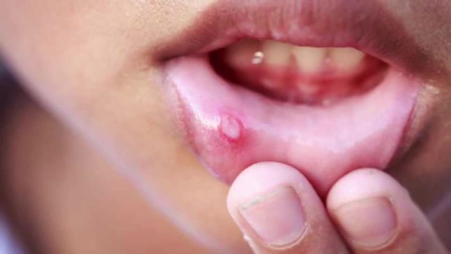 علل ایجاد آفت دهانی و راه های درمان آن | ویدیو