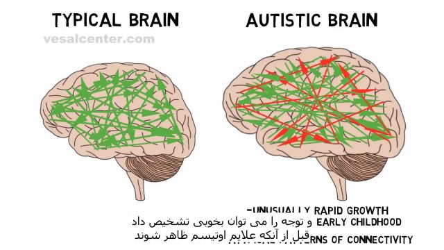 اوتیسم و نقشه مغزی