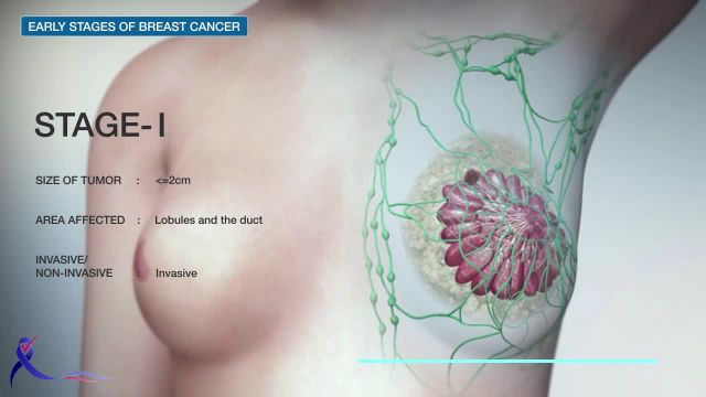 جراحی سرطان سینه | عمل جراحی سرطان پستان