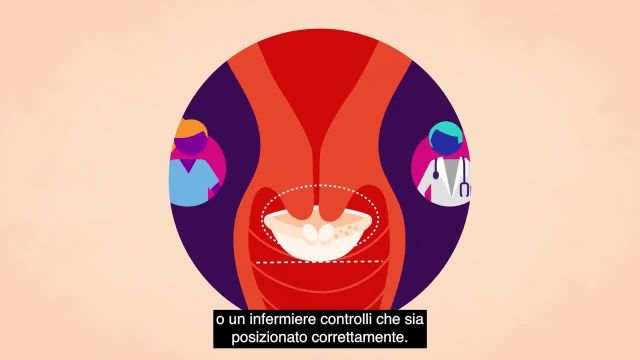 پیشگیری از بارداری در ایتالیا