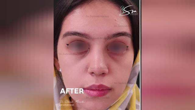 عمل زیبایی بینی -بهترین جراح بینی در تهران