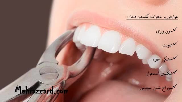 کشیدن دندان (از دست رفتن دندان)