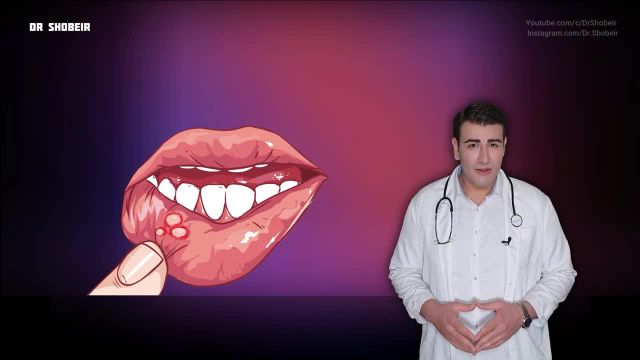آفت دهان چیست ؟ آفت های دهان چند نوع دارند و درمان آن چیست؟