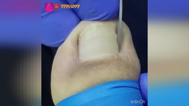 چه زمانی جراحی ناخن پا لازم است