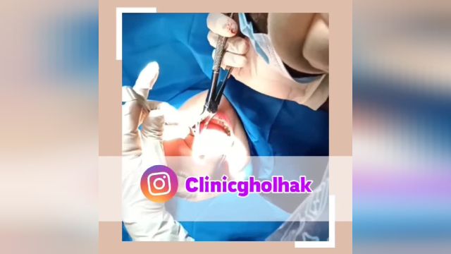 کشیدن دندان و کاشت ایمپلنت همزمان در کلینیک