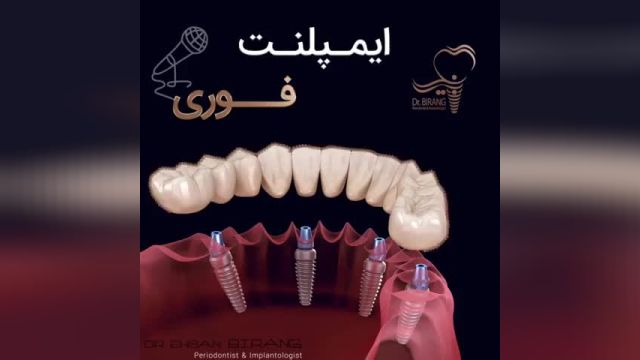 فیلم ایمپلنت فوری دندان
