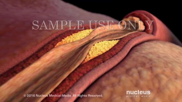 آزمایش خون برای کلسترول | ویدیو