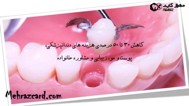 بریج دندان (پل دندان)