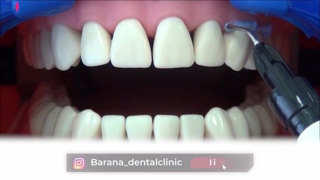 بلیچینگ دندان بهتر است یا ارتودنسی؟