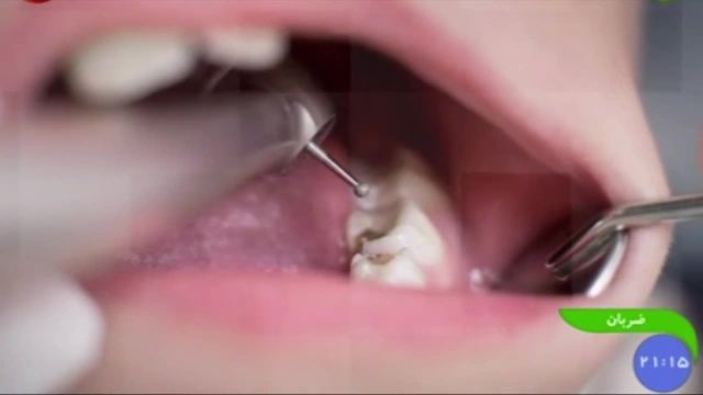 چه مواد غذایی برای دندان ها مفید هستند و کدامیک مضر هستند؟