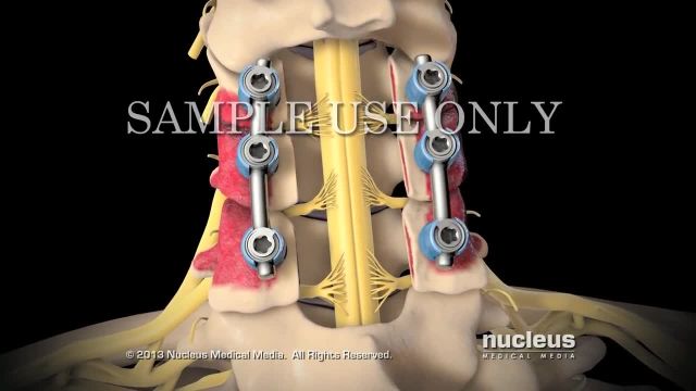 جراحی گردن | لامینکتومی گردن رحم | سلامت هسته