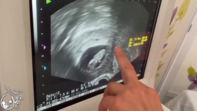 حاملگی با IVF و رحم جایگزین در مادر 39 ساله با سابقه بیماری لوپوس و 12 سال نازایی