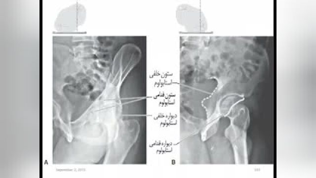 تدریس جامع و کامل ارتوپدی | جلسه ششم: شکستگی ها و دررفتگی های لگن | دانشگاه علوم پزشکی تهران