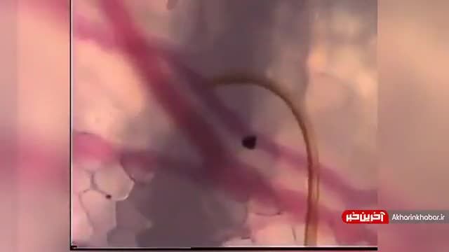 پشه در حال پیدا کردن رگ و مکیدن خون | ویدیو