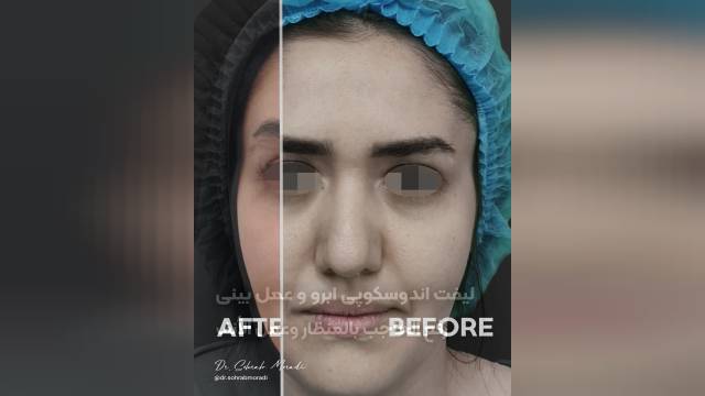 لیفت اندوسکوپیک ابرو و عمل بینی-بهترین جراح بینی در تهران
