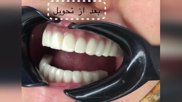 فیلم ویدیوی کاشت و تحویل ایمپلنت دندان