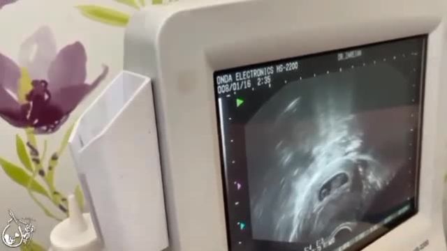 حاملگی با IVF با تشخیص تخمدانهای پلی کیستیک در سن 24 سالگی