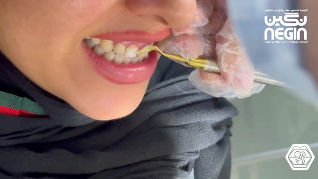 انتخاب رنگ فیسینگ دندان - دکتر فائزه تدین