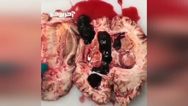 اگر میخواهید بدانید که خونریزی مغزی چگونه اتفاق می افتد این ویدیو را از دست ندهید