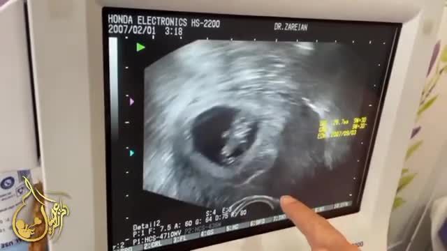 ویدئویی از بارداری با رحم جایگزین و اهدای تخمک