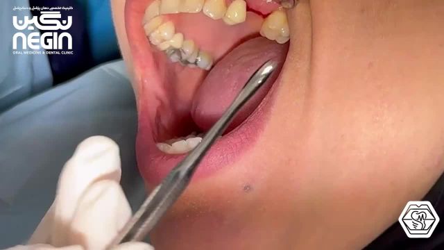بستن هیلینگ دندان - دکتر نگین اثنی عشری