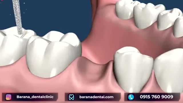 بریج چگونه می تواند سلامت دندان ها را سبب شود؟
